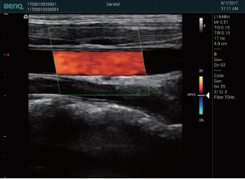 Carotid Artery