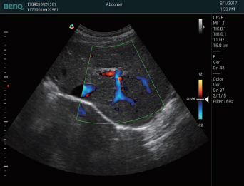 Hepatic Portal Vein