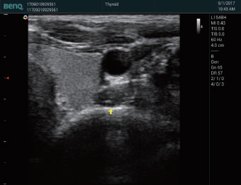 Thyroid