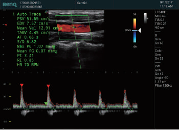 Vascular measurement